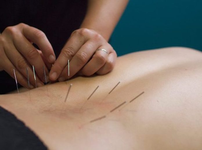 Dry needling physio Melbourne