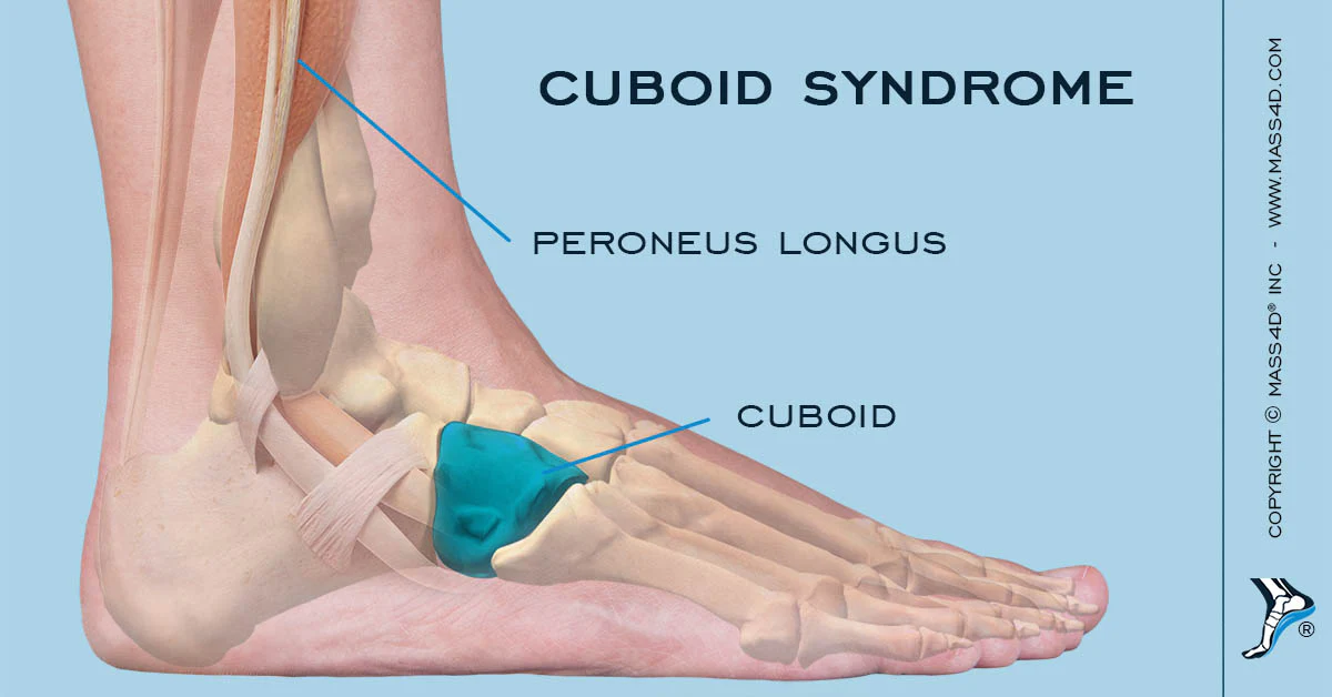 shoes for cuboid Syndrome