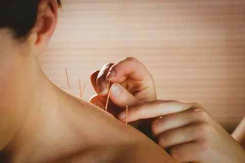 dry needling Melbourne