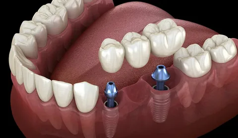 Dental implants Dulwich Hill